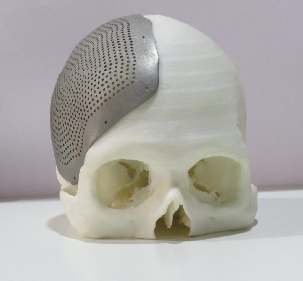 3D Printed Patent Specific Implants